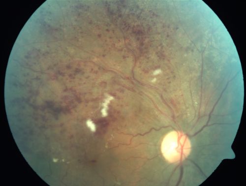 Branch Retinal Vein Occlusion with Cotton Wool Spot 
70-year-old man with blurred vision in the right eye for about one or two months. OD is 20/80, OS is 20/25.
