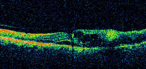 Branch Retinal Vein Occlusion with Cotton Wool Spot 
70-year-old man with blurred vision in the right eye for about one or two months. OD is 20/80, OS is 20/25.
