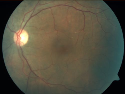 Branch Retinal Vein Occlusion with Cotton Wool Spot 
70-year-old man with blurred vision in the right eye for about one or two months. OD is 20/80, OS is 20/25.
