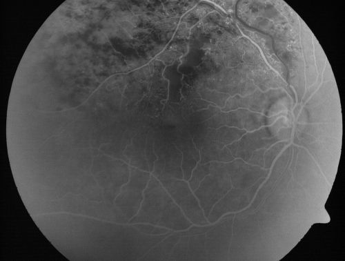Branch Retinal Vein Occlusion with Cotton Wool Spot 
70-year-old man with blurred vision in the right eye for about one or two months. OD is 20/80, OS is 20/25.
