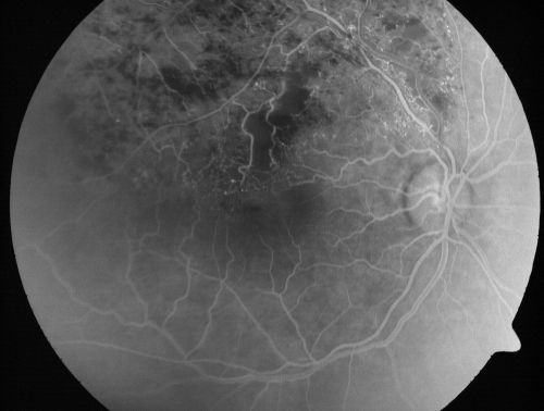 Branch Retinal Vein Occlusion with Cotton Wool Spot 
70-year-old man with blurred vision in the right eye for about one or two months. OD is 20/80, OS is 20/25.
