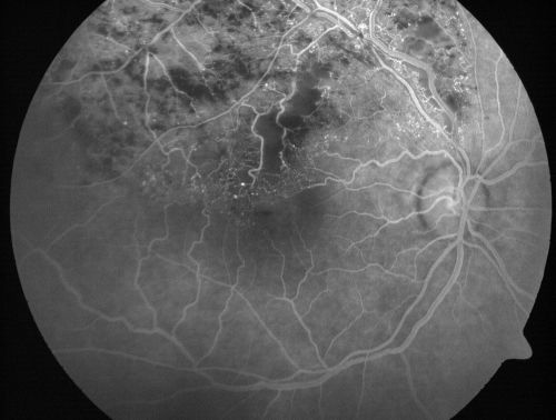 Branch Retinal Vein Occlusion with Cotton Wool Spot 
70-year-old man with blurred vision in the right eye for about one or two months. OD is 20/80, OS is 20/25.
