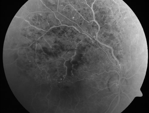 Branch Retinal Vein Occlusion with Cotton Wool Spot 
70-year-old man with blurred vision in the right eye for about one or two months. OD is 20/80, OS is 20/25.
