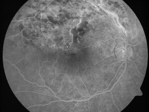 Branch Retinal Vein Occlusion with Cotton Wool Spot 
70-year-old man with blurred vision in the right eye for about one or two months. OD is 20/80, OS is 20/25.
