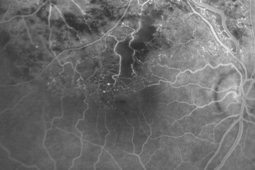 Branch Retinal Vein Occlusion with Cotton Wool Spot 
70-year-old man with blurred vision in the right eye for about one or two months. OD is 20/80, OS is 20/25.
