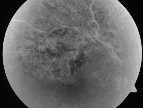 Branch Retinal Vein Occlusion with Cotton Wool Spot 
70-year-old man with blurred vision in the right eye for about one or two months. OD is 20/80, OS is 20/25.
