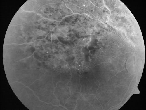 Branch Retinal Vein Occlusion with Cotton Wool Spot 
70-year-old man with blurred vision in the right eye for about one or two months. OD is 20/80, OS is 20/25.
