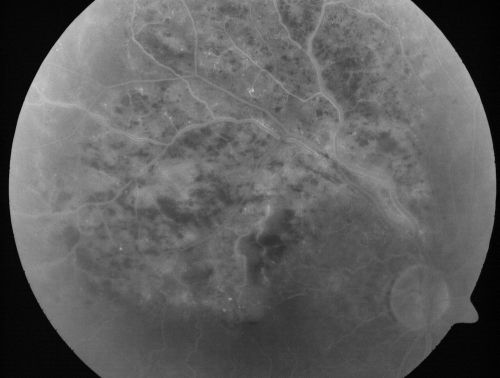 Branch Retinal Vein Occlusion with Cotton Wool Spot 
70-year-old man with blurred vision in the right eye for about one or two months. OD is 20/80, OS is 20/25.
