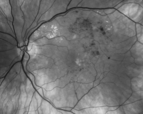 New BRVO Left Eye Old BRVO Right Eye  - Left Eye Shows Twig Superior Vein Occlusion with Edema
90-year-old man decreased vision maybe one year since cataract surgery he is no longer able to read. OD 20/200,  OS 20/200
