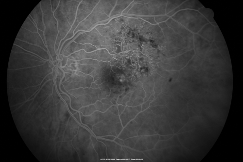 New BRVO Left Eye Old BRVO Right Eye  - Left Eye Shows Twig Superior Vein Occlusion with Edema
90-year-old man decreased vision maybe one year since cataract surgery he is no longer able to read. OD 20/200,  OS 20/200
