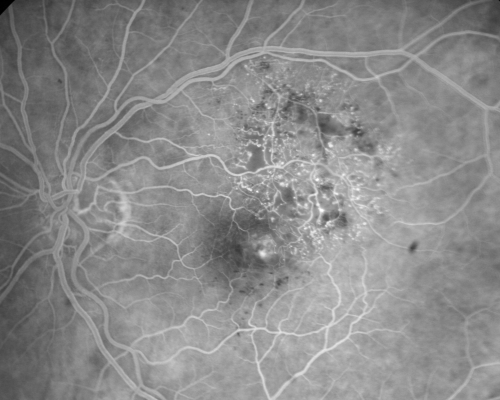 New BRVO Left Eye Old BRVO Right Eye  - Left Eye Shows Twig Superior Vein Occlusion with Edema
90-year-old man decreased vision maybe one year since cataract surgery he is no longer able to read. OD 20/200,  OS 20/200
