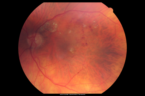 New BRVO Left Eye Old BRVO Right Eye  - Left Eye Shows Twig Superior Vein Occlusion with Edema
90-year-old man decreased vision maybe one year since cataract surgery he is no longer able to read. OD 20/200,  OS 20/200

