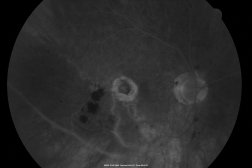 New BRVO Left Eye Old BRVO Right Eye  - Right Eye Showing Bulls Eye Atrophy from Chronic CME and Non-Perfusion Infero-temporally
90-year-old man decreased vision maybe one year since cataract surgery he is no longer able to read. OD 20/200,  OS 20/200
