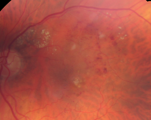 New BRVO Left Eye Old BRVO Right Eye  - Left Eye Shows Twig Superior Vein Occlusion with Edema
90-year-old man decreased vision maybe one year since cataract surgery he is no longer able to read. OD 20/200,  OS 20/200

