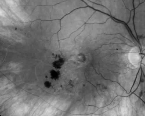 New BRVO Left Eye Old BRVO Right Eye  - Right Eye Showing Bulls Eye Atrophy from Chronic CME and Non-Perfusion Infero-temporally
90-year-old man decreased vision maybe one year since cataract surgery he is no longer able to read. OD 20/200,  OS 20/200

