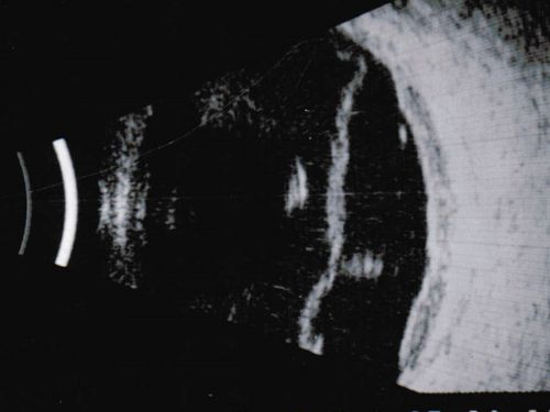 Choroidal Melanoma - Exudative Retinal Detachment 82 Year Old Man B Scan Ultrasound Transverce
82-year-old man who had 3 falls 2 weeks ago. After the falls he started checking his vision and noticed there was a veil over the left eye, which he had seen for about two weeks in the superior visual field.  OD 20/25,  OS 20/40
(patient was medically never well enough for brachytherapy and died 6 months later from heart disease) 
