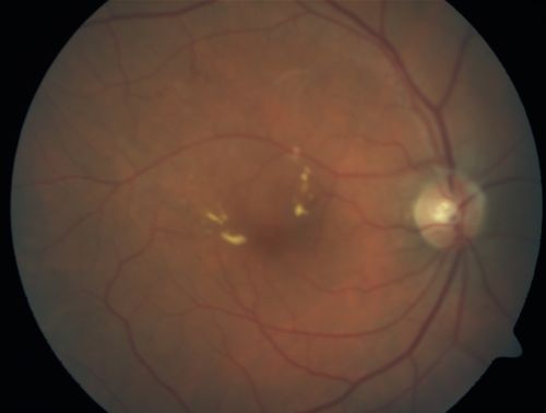 BRVO with collaterals and cystoid macular edema
66 Year Old Man with has had a branch retinal vein occlusion in the right eye with vision loss for the last few months.  OD is 20/40, OS is 20/20.  IOP:  OD 18, OS 19.  There is a superotemporal macular branch retinal vein occlusion with edema, hemorrhage, and exudate.
OCT SCAN:  The right eye shows edema with a central foveal thickness of 354 microns FA: shows remodeling of the superotemporal vasculature.  There are already venous-venous collaterals, suggesting the vein occlusion may be a little more than a few months old.  There are multiple microaneurysms superotemporal to the fovea, and there is leakage in the late frames involving the fovea.

Võtmesõnad: brvo;cme;cystoid macular edema;collaterals
