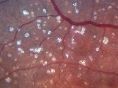Calcified Drusen - Dry Age-related Macular Degeneration - Geographic Atrophy
87 Year old woman with dry age-related macular degeneration in both eyes.With both eyes open she is fine, but when she closes the left eye, things are wavier.

VISUAL ACUITY:  Vision OD is 20/100, OS is 20/40.
