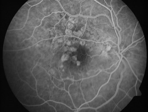 Calcified Drusen - Dry Age-related Macular Degeneration - Geographic Atrophy
87 Year old woman with dry age-related macular degeneration in both eyes.With both eyes open she is fine, but when she closes the left eye, things are wavier.

VISUAL ACUITY:  Vision OD is 20/100, OS is 20/40.
