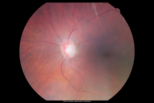 Central Retinal Artery Occlusion less than 24 hours - 69 year old man VA light perception
