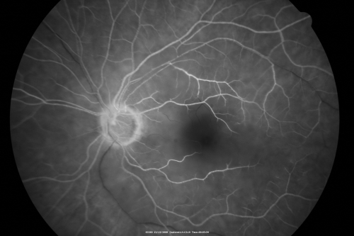 Mots-clés: Central Retinal Artery Occlusion less than 24 hours - 69 year old man VA light perception