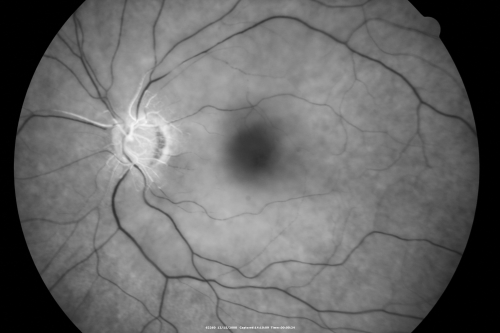 Central Retinal Artery Occlusion less than 24 hours - 69 year old man VA light perception
