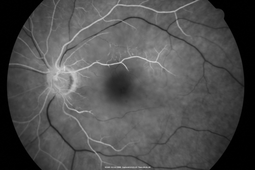 Central Retinal Artery Occlusion less than 24 hours - 69 year old man VA light perception

