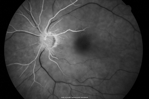 Central Retinal Artery Occlusion less than 24 hours - 69 year old man VA light perception
