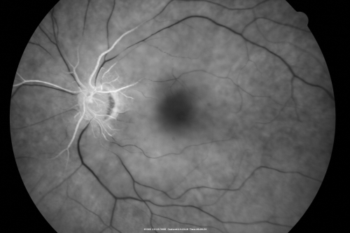 Central Retinal Artery Occlusion less than 24 hours - 69 year old man VA light perception
