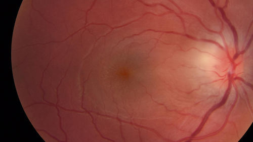 Cat Scratch - Neuroretinitis OD AND retinitis OS - Bartonella henselae positive
27 year old female with exposure to cats and prior fever.  Reports with recent vision loss right eye.  She was treated with doxycycline and within 2 weeks the right eye looks better.  Then she skipped all follow-up visits.  The right eye presented 20/200 and the left 20/16

