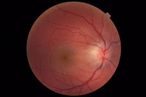 Cat Scratch - Neuroretinitis OD AND retinitis OS - Bartonella henselae positive
27 year old female with exposure to cats and prior fever.  Reports with recent vision loss right eye.  She was treated with doxycycline and within 2 weeks the right eye looks better.  Then she skipped all follow-up visits.  The right eye presented 20/200 and the left 20/16
