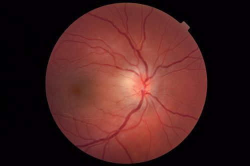 Cat Scratch - Neuroretinitis OD AND retinitis OS - Bartonella henselae positive
27 year old female with exposure to cats and prior fever.  Reports with recent vision loss right eye.  She was treated with doxycycline and within 2 weeks the right eye looks better.  Then she skipped all follow-up visits.  The right eye presented 20/200 and the left 20/16
