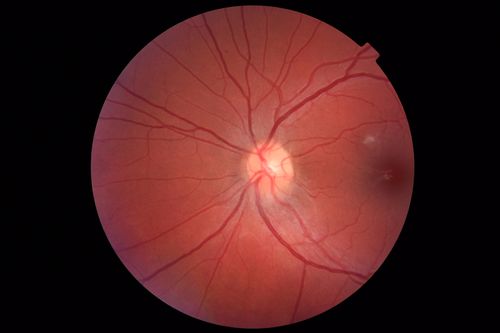 Cat Scratch - Neuroretinitis OD AND retinitis OS - Bartonella henselae positive
27 year old female with exposure to cats and prior fever.  Reports with recent vision loss right eye.  She was treated with doxycycline and within 2 weeks the right eye looks better.  Then she skipped all follow-up visits.  The right eye presented 20/200 and the left 20/16
