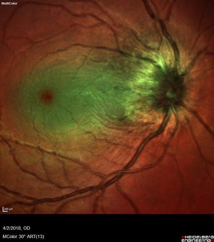 Cat Scratch - Neuroretinitis OD AND retinitis OS - Bartonella henselae positive
27 year old female with exposure to cats and prior fever.  Reports with recent vision loss right eye.  She was treated with doxycycline and within 2 weeks the right eye looks better.  Then she skipped all follow-up visits.  The right eye presented 20/200 and the left 20/16

