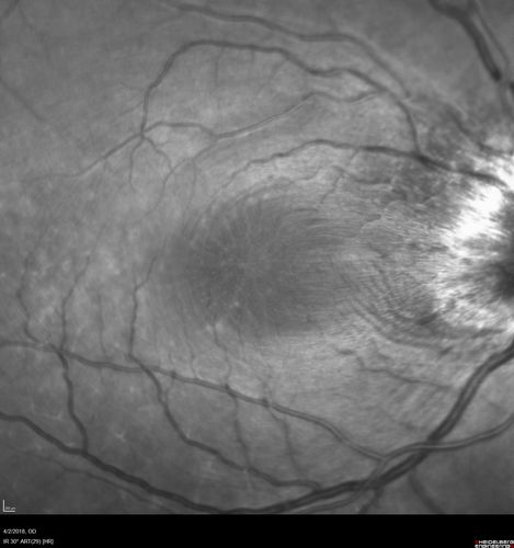 Cat Scratch - Neuroretinitis OD AND retinitis OS - Bartonella henselae positive
27 year old female with exposure to cats and prior fever.  Reports with recent vision loss right eye.  She was treated with doxycycline and within 2 weeks the right eye looks better.  Then she skipped all follow-up visits.  The right eye presented 20/200 and the left 20/16

