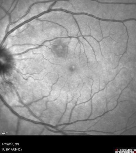 Cat Scratch - Neuroretinitis OD AND retinitis OS - Bartonella henselae positive
27 year old female with exposure to cats and prior fever.  Reports with recent vision loss right eye.  She was treated with doxycycline and within 2 weeks the right eye looks better.  Then she skipped all follow-up visits.  The right eye presented 20/200 and the left 20/16
