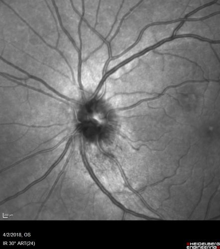 Cat Scratch - Neuroretinitis OD AND retinitis OS - Bartonella henselae positive
27 year old female with exposure to cats and prior fever.  Reports with recent vision loss right eye.  She was treated with doxycycline and within 2 weeks the right eye looks better.  Then she skipped all follow-up visits.  The right eye presented 20/200 and the left 20/16
