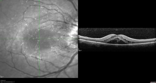 Cat Scratch - Neuroretinitis OD AND retinitis OS - Bartonella henselae positive
27 year old female with exposure to cats and prior fever.  Reports with recent vision loss right eye.  She was treated with doxycycline and within 2 weeks the right eye looks better.  Then she skipped all follow-up visits.  The right eye presented 20/200 and the left 20/16
