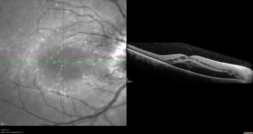 Cat Scratch - Neuroretinitis OD AND retinitis OS - Bartonella henselae positive
27 year old female with exposure to cats and prior fever.  Reports with recent vision loss right eye.  She was treated with doxycycline and within 2 weeks the right eye looks better.  Then she skipped all follow-up visits.  The right eye presented 20/200 and the left 20/16
