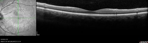 Cat Scratch - Neuroretinitis OD AND retinitis OS - Bartonella henselae positive
27 year old female with exposure to cats and prior fever.  Reports with recent vision loss right eye.  She was treated with doxycycline and within 2 weeks the right eye looks better.  Then she skipped all follow-up visits.  The right eye presented 20/200 and the left 20/16
