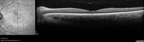 Cat Scratch - Neuroretinitis OD AND retinitis OS - Bartonella henselae positive
27 year old female with exposure to cats and prior fever.  Reports with recent vision loss right eye.  She was treated with doxycycline and within 2 weeks the right eye looks better.  Then she skipped all follow-up visits.  The right eye presented 20/200 and the left 20/16
