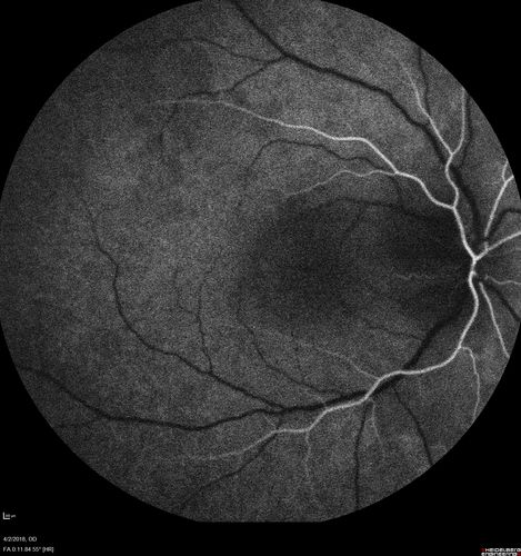 Cat Scratch - Neuroretinitis OD AND retinitis OS - Bartonella henselae positive
27 year old female with exposure to cats and prior fever.  Reports with recent vision loss right eye.  She was treated with doxycycline and within 2 weeks the right eye looks better.  Then she skipped all follow-up visits.  The right eye presented 20/200 and the left 20/16
