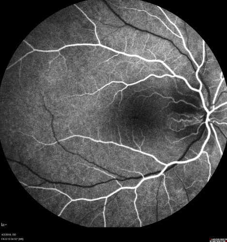Cat Scratch - Neuroretinitis OD AND retinitis OS - Bartonella henselae positive
27 year old female with exposure to cats and prior fever.  Reports with recent vision loss right eye.  She was treated with doxycycline and within 2 weeks the right eye looks better.  Then she skipped all follow-up visits.  The right eye presented 20/200 and the left 20/16
