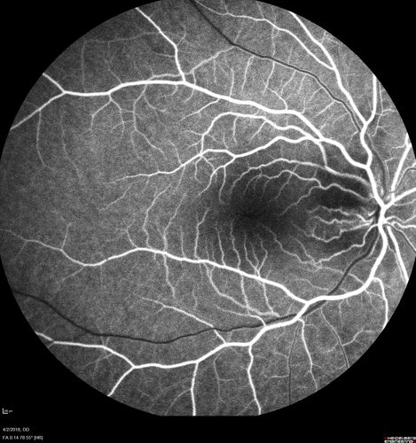 Cat Scratch - Neuroretinitis OD AND retinitis OS - Bartonella henselae positive
27 year old female with exposure to cats and prior fever.  Reports with recent vision loss right eye.  She was treated with doxycycline and within 2 weeks the right eye looks better.  Then she skipped all follow-up visits.  The right eye presented 20/200 and the left 20/16
