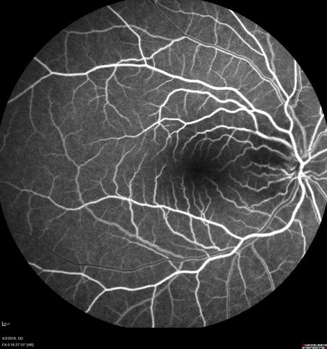 Cat Scratch - Neuroretinitis OD AND retinitis OS - Bartonella henselae positive
27 year old female with exposure to cats and prior fever.  Reports with recent vision loss right eye.  She was treated with doxycycline and within 2 weeks the right eye looks better.  Then she skipped all follow-up visits.  The right eye presented 20/200 and the left 20/16
