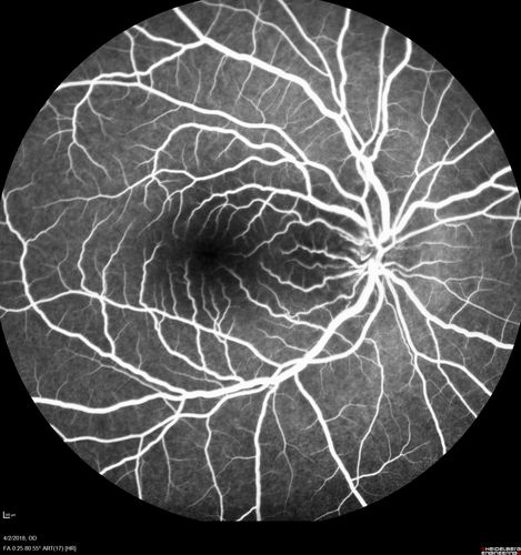 Cat Scratch - Neuroretinitis OD AND retinitis OS - Bartonella henselae positive
27 year old female with exposure to cats and prior fever.  Reports with recent vision loss right eye.  She was treated with doxycycline and within 2 weeks the right eye looks better.  Then she skipped all follow-up visits.  The right eye presented 20/200 and the left 20/16
