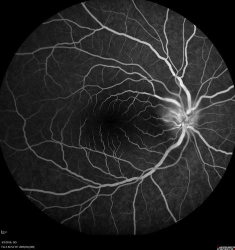 Cat Scratch - Neuroretinitis OD AND retinitis OS - Bartonella henselae positive
27 year old female with exposure to cats and prior fever.  Reports with recent vision loss right eye.  She was treated with doxycycline and within 2 weeks the right eye looks better.  Then she skipped all follow-up visits.  The right eye presented 20/200 and the left 20/16

