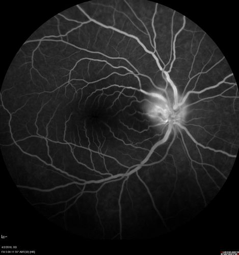 Cat Scratch - Neuroretinitis OD AND retinitis OS - Bartonella henselae positive
27 year old female with exposure to cats and prior fever.  Reports with recent vision loss right eye.  She was treated with doxycycline and within 2 weeks the right eye looks better.  Then she skipped all follow-up visits.  The right eye presented 20/200 and the left 20/16
