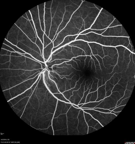 Cat Scratch - Neuroretinitis OD AND retinitis OS - Bartonella henselae positive
27 year old female with exposure to cats and prior fever.  Reports with recent vision loss right eye.  She was treated with doxycycline and within 2 weeks the right eye looks better.  Then she skipped all follow-up visits.  The right eye presented 20/200 and the left 20/16
