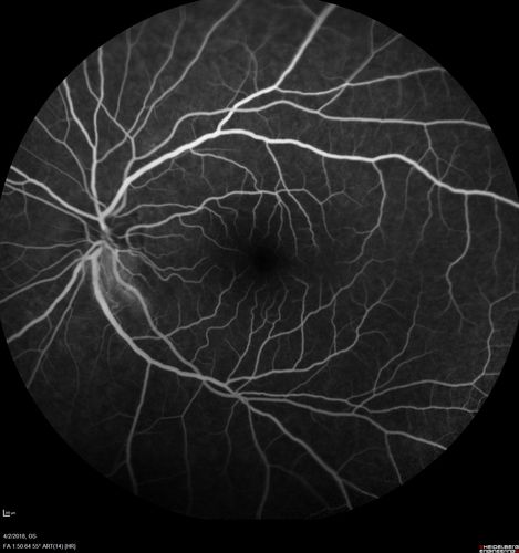 Cat Scratch - Neuroretinitis OD AND retinitis OS - Bartonella henselae positive
27 year old female with exposure to cats and prior fever.  Reports with recent vision loss right eye.  She was treated with doxycycline and within 2 weeks the right eye looks better.  Then she skipped all follow-up visits.  The right eye presented 20/200 and the left 20/16
